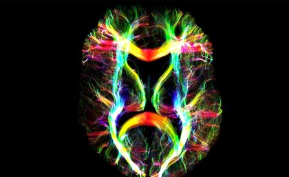 MRI image - white matter fibres in the human brain
